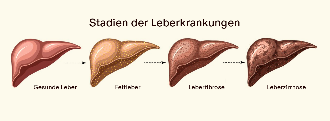 Fettleber: Die unterschätzte Gefahr