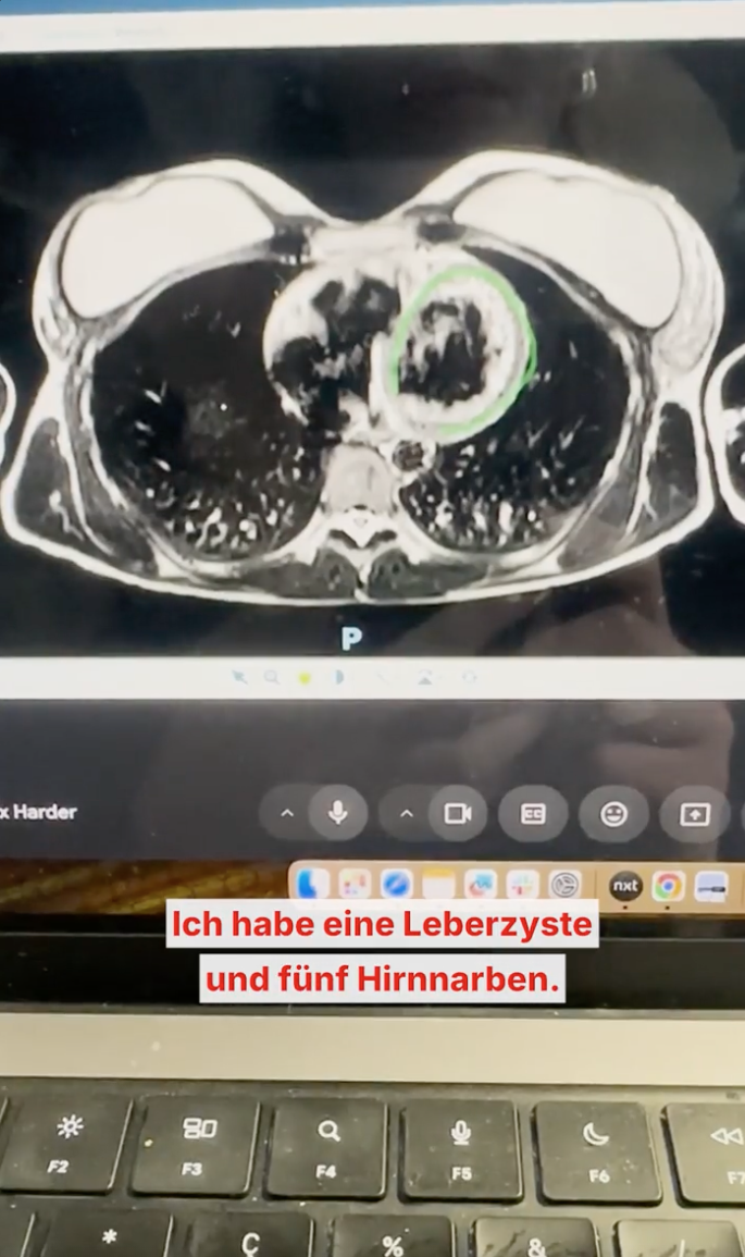 Blick: Wie kann ich wirklich wissen ob ich einen Tumor habe?