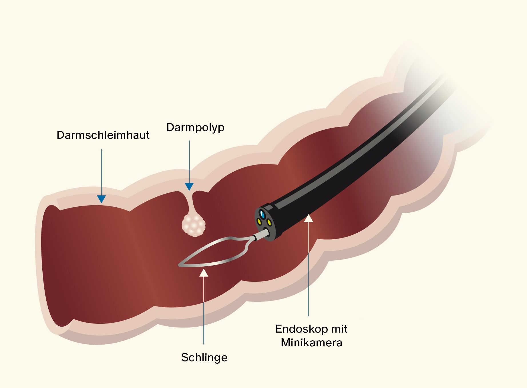 Colorectal Cancer Screening: What You Need to Know for Early Detection