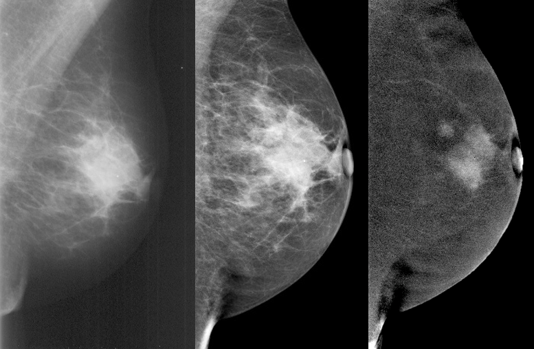 The Ultimate Guide to Mammography: What to Expect and When to Get Screened