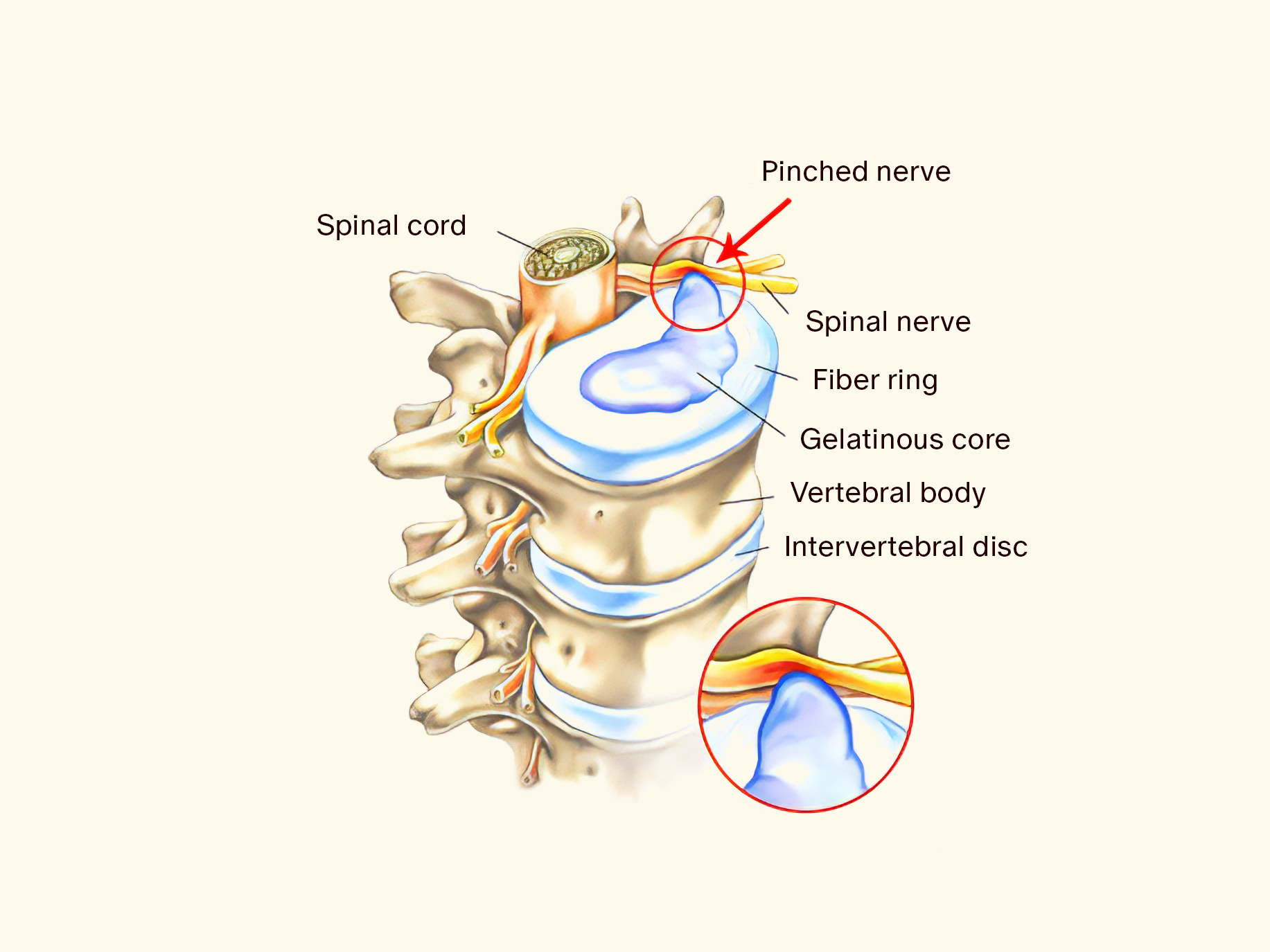 pinched nerve